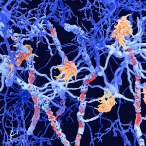 Image article Sclérose en plaques : l’IA révèle deux nouveaux sous-types biologiques grâce à l’IRM et à un biomarqueur sanguin