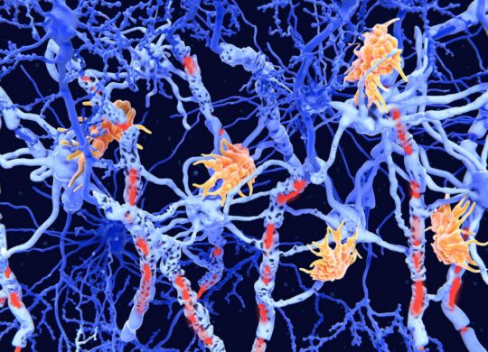 Sclerose en plaques iA