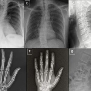 Image article Des radiologues peinent à repérer les radiographies générées par IA